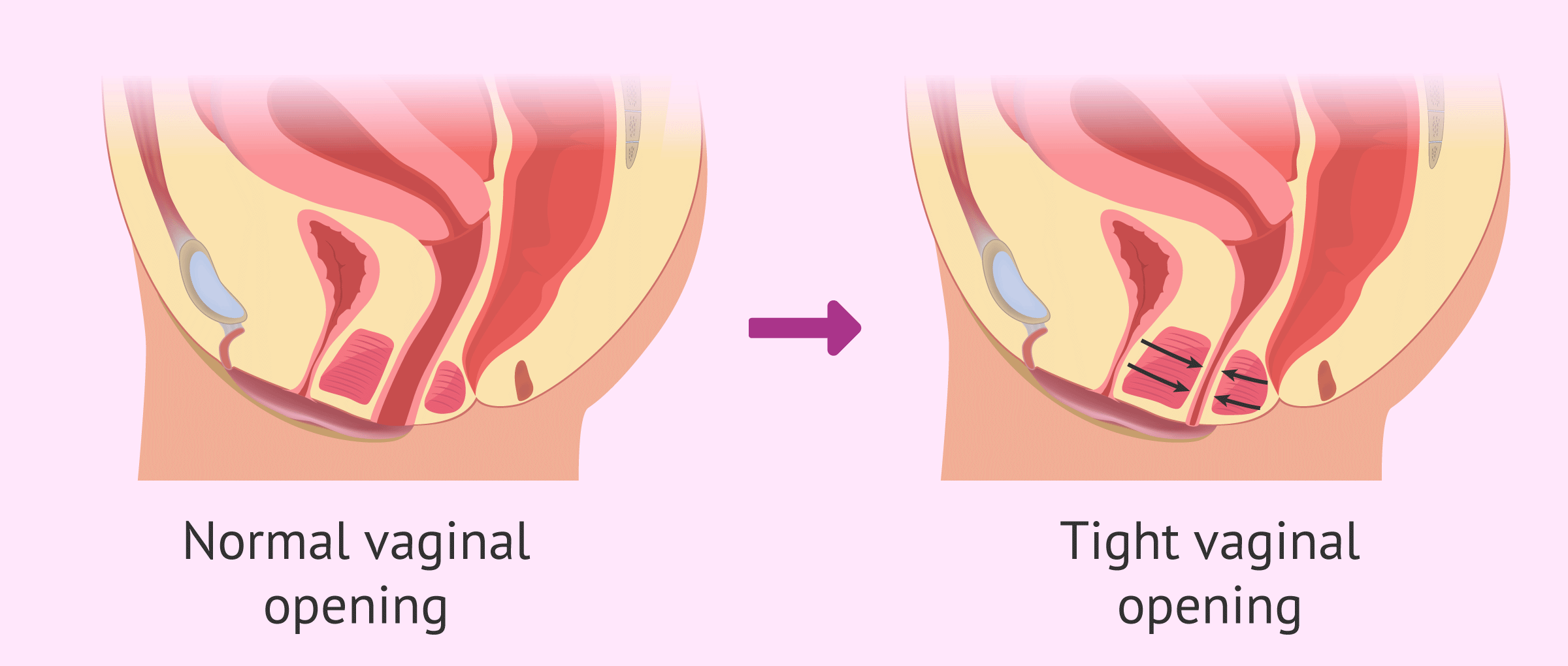Diagram explaining vaginismus